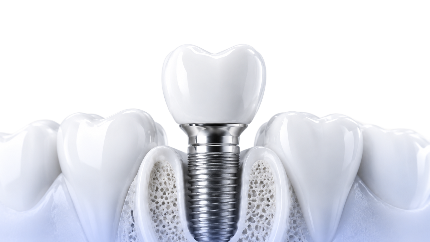 Implante dental con corona en un corte de hueso, entre dientes naturales